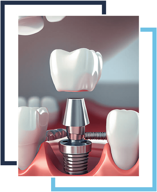 A tooth implant being placed in the mouth of someone.