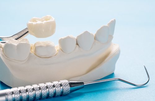 A dental model with a tooth crown and teeth being worked on.